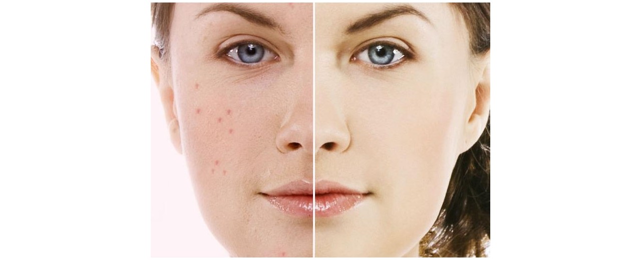 Acne: un problema da grandi